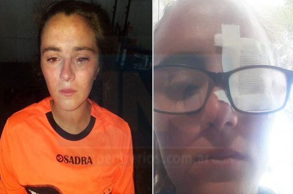 Florencia Botto sufrió una dura agresión en un partido de fútbol femenino en Paraná. Gentileza: Diario UNO