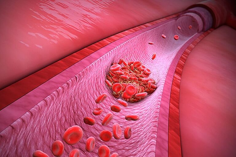 En Argentina la trombofilia no es considerada una enfermedad sino un trastorno en la coagulación en la sangre.