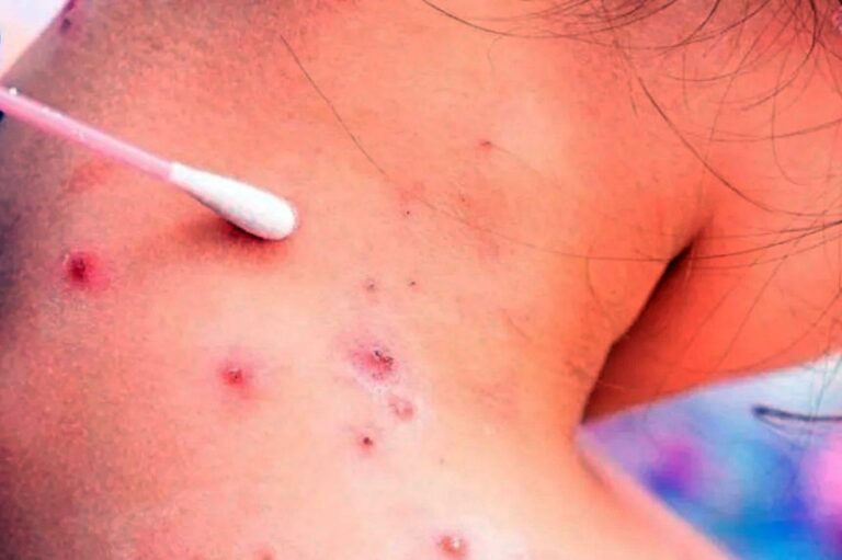Todos los casos se caracterizan por presentar exantemas vesiculares en diferentes lugares del cuerpo. Archivo